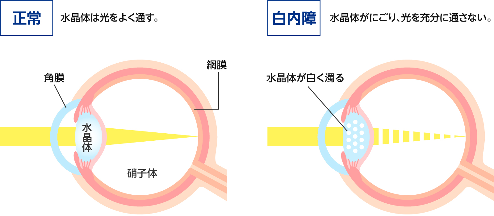 白内障症状