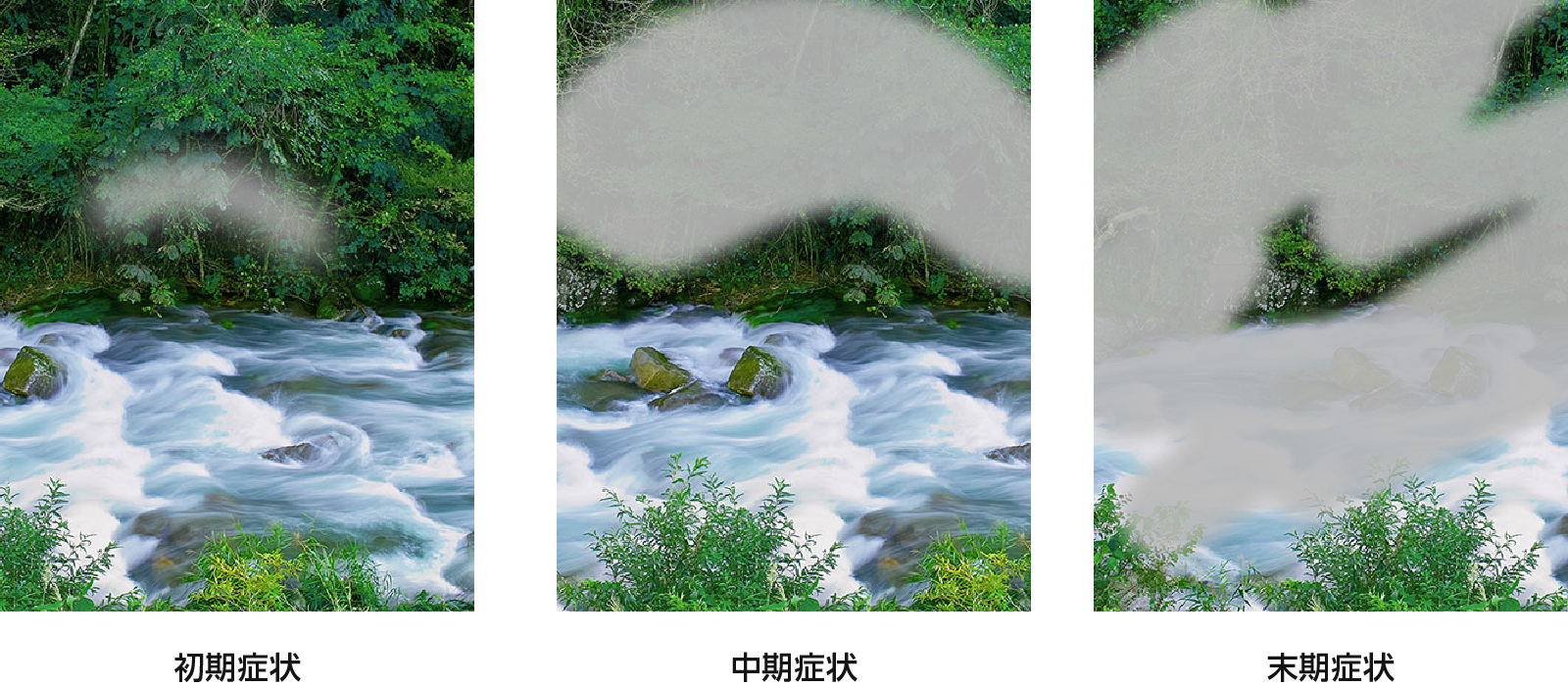 緑内障症状